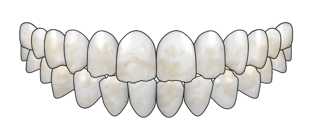 graphic of a set of teeth that are chipped and stained