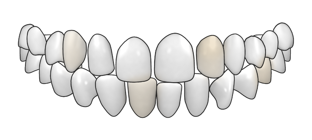 graphic of a set of teeth that are spaced and uneven