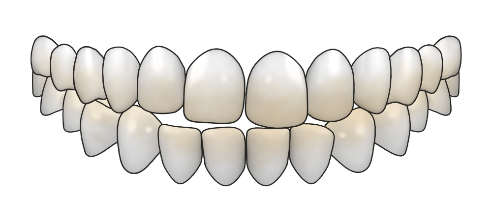graphic of a set of teeth that are worn down